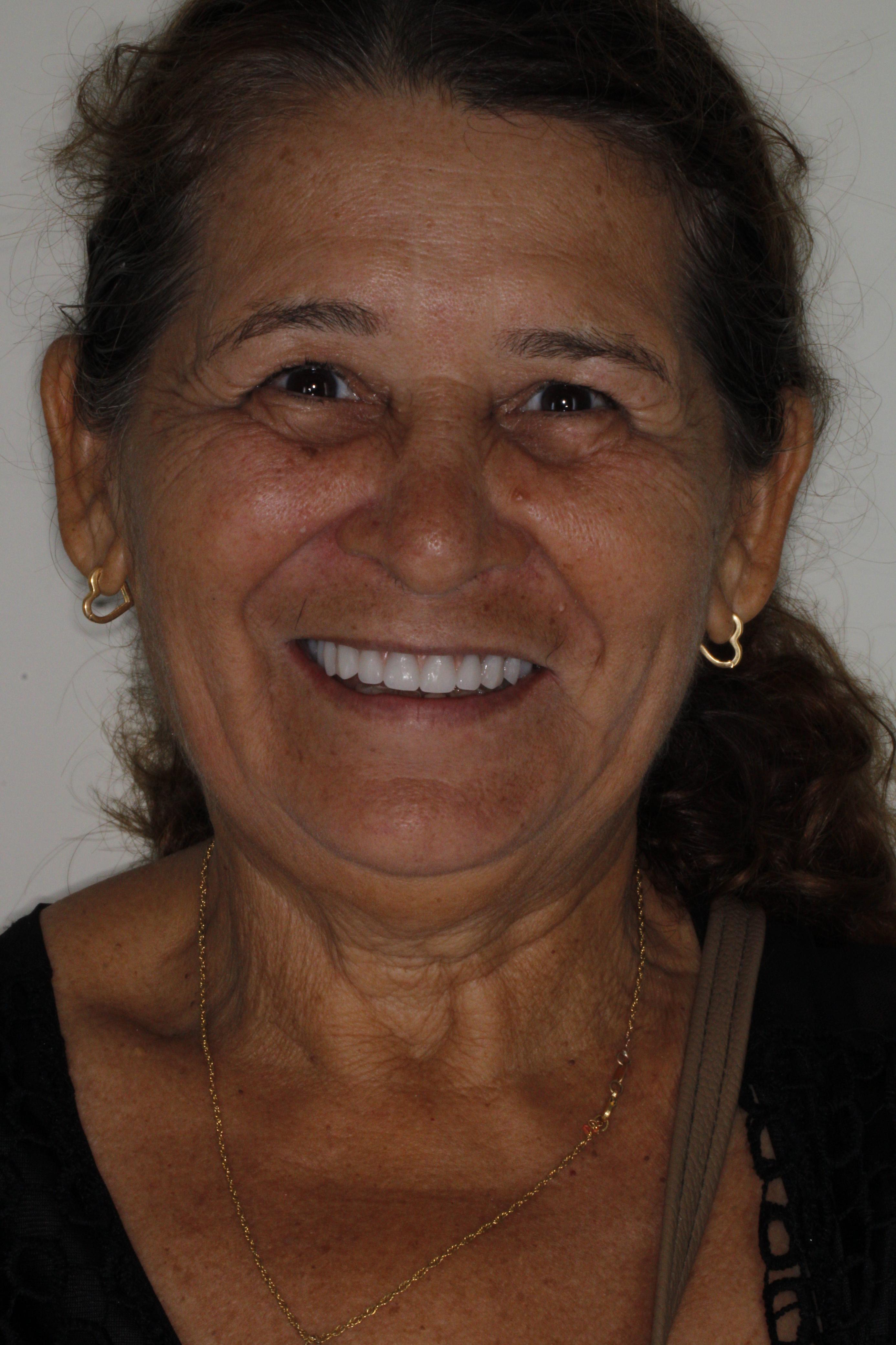 Depois de estética dental: sorriso do caso 2