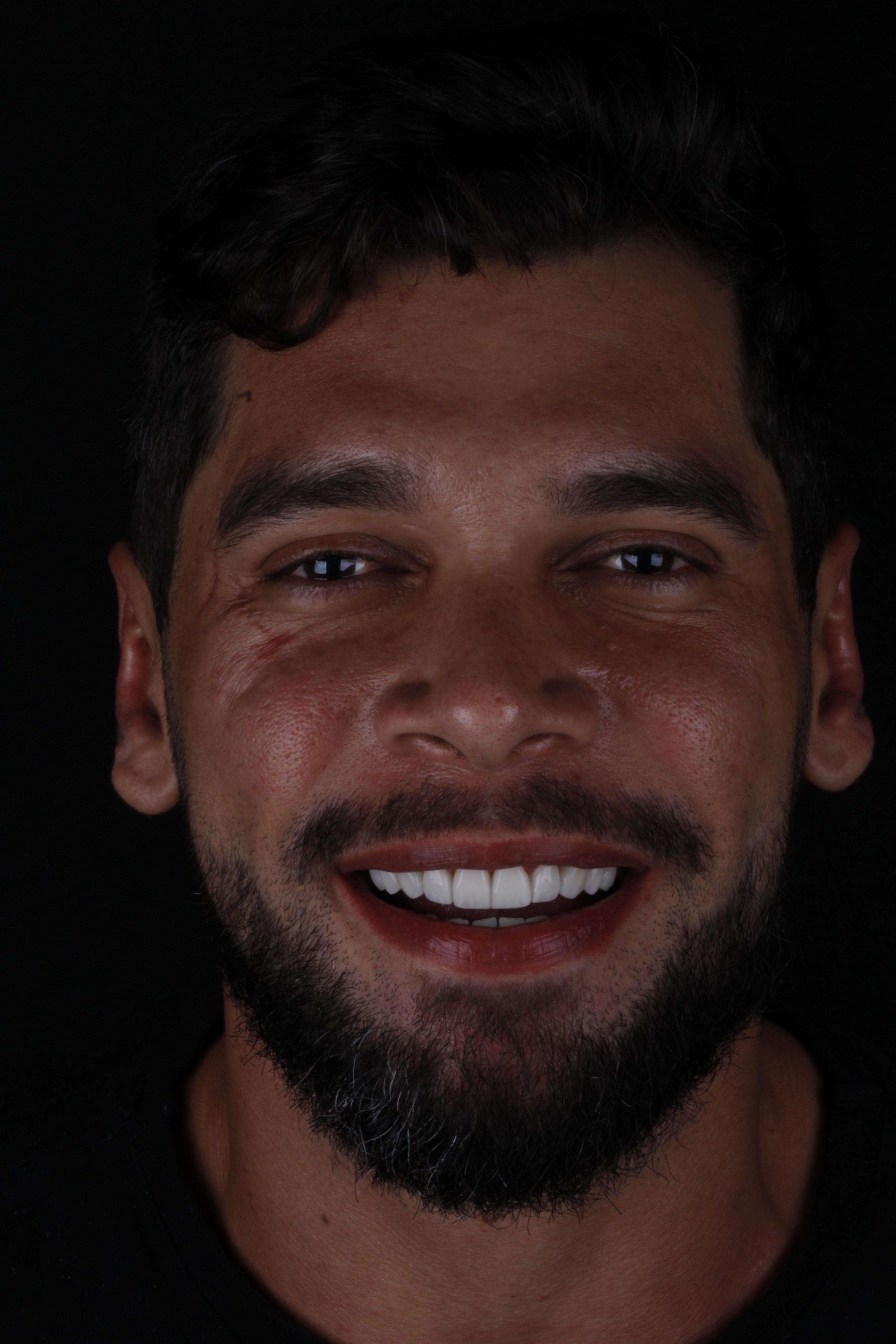 Antes e depois de estética dental: sorriso do caso 1 — depois